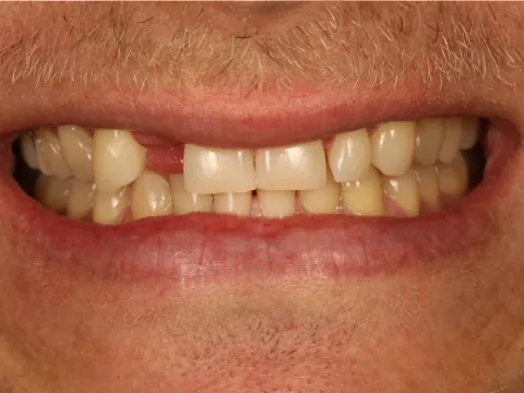 Before single-tooth implant treatment